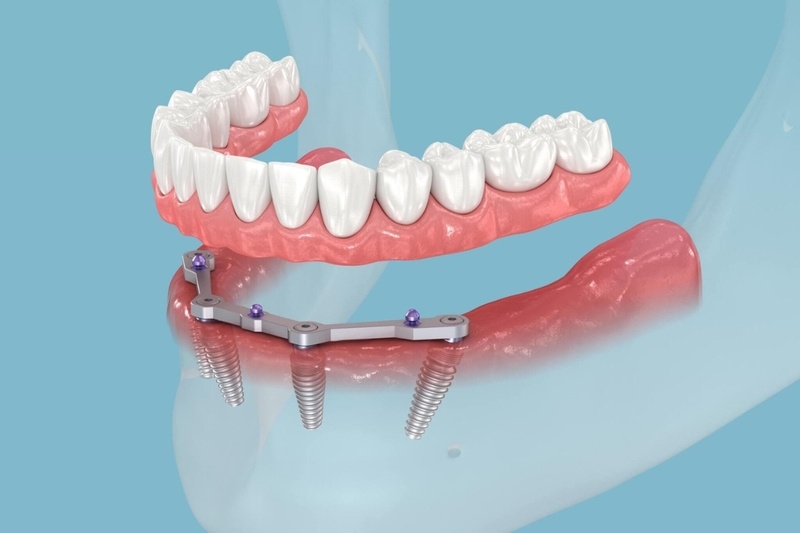 All-on-4 dental implants in New York | Could You Be A Candidate For All-on-4® Implants?
