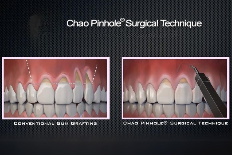 Chao Pinhole Grafting | Understanding Chao Pinhole® Grafting