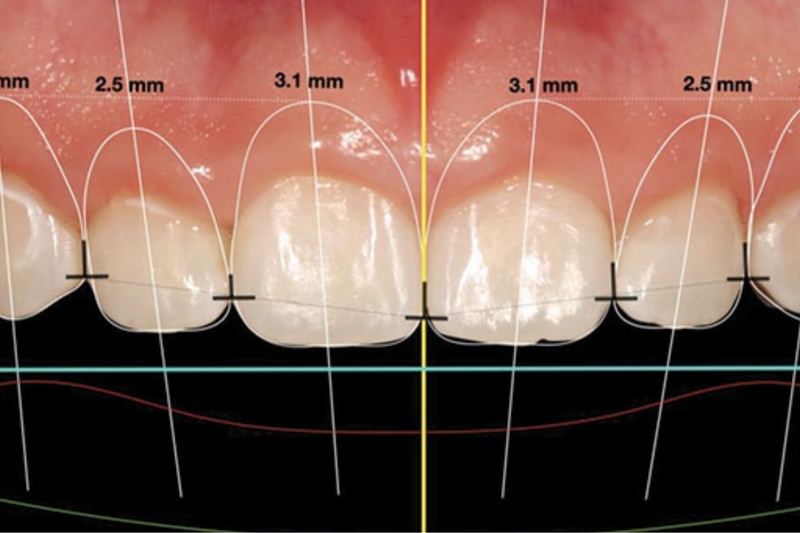 Crown lengthening | Reasons Why Crown Lengthening Might Be the Right Choice