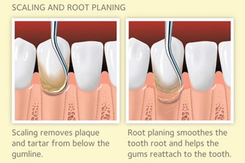 Scaling and root planning | Scaling And Root Planing Explained
