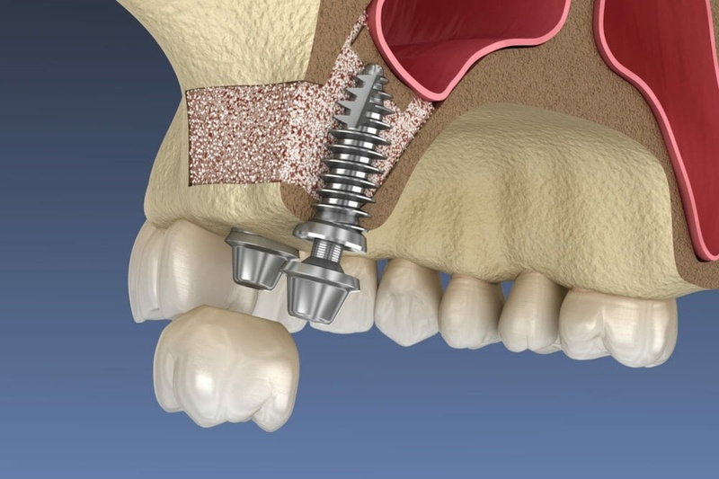 Sinus Lift | Understanding Sinus Lift Surgery