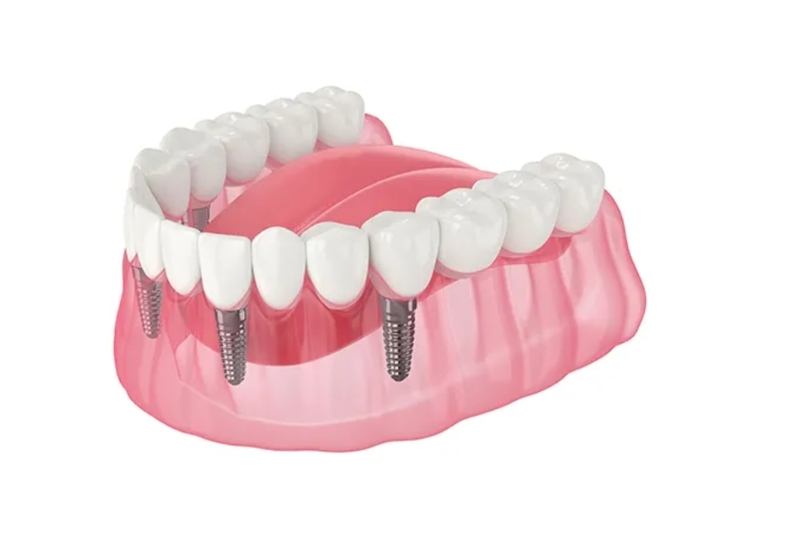 Dental implant Bridges | Implant Bridges vs. Traditional Dentures
