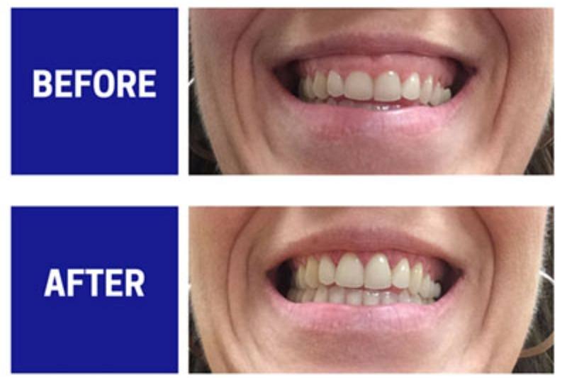 Crown lengthening | The Benefits Of Crown Lengthening For Gum Health