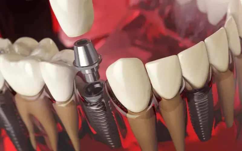 How Long Do All-On-4 Implants Last