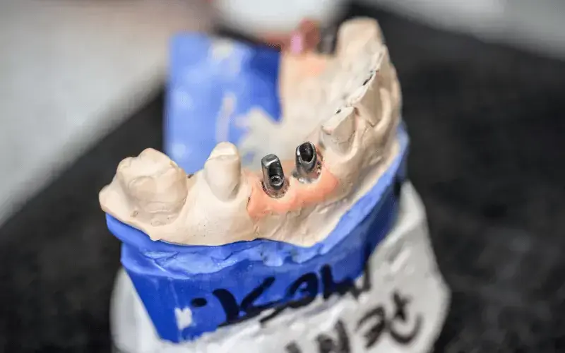 How to Take Care of Your All-on-4 Dental Implants