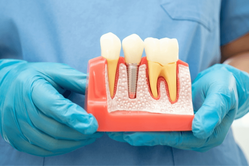 Is Getting Dental Implants Painful?