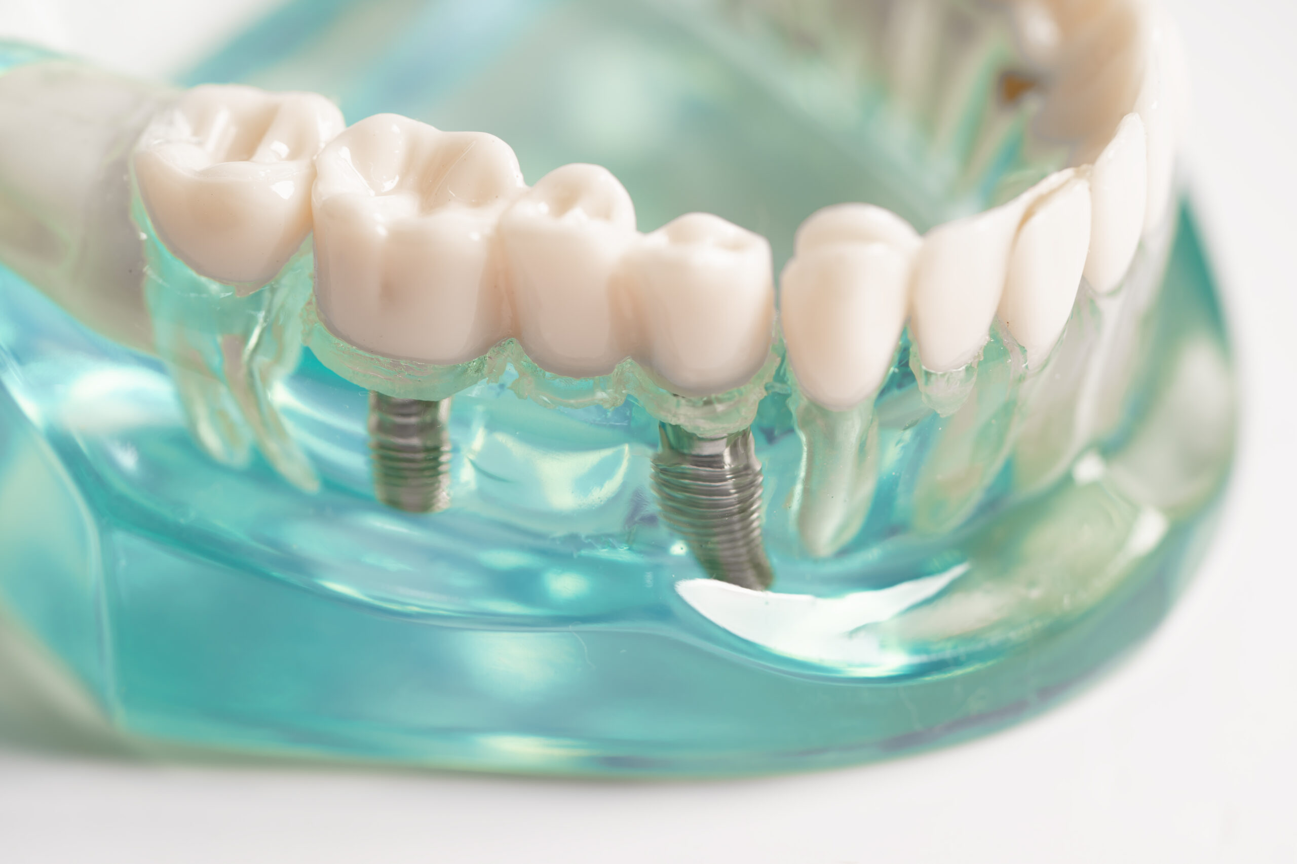 Do Dental Implants Feel Like Real Teeth?
