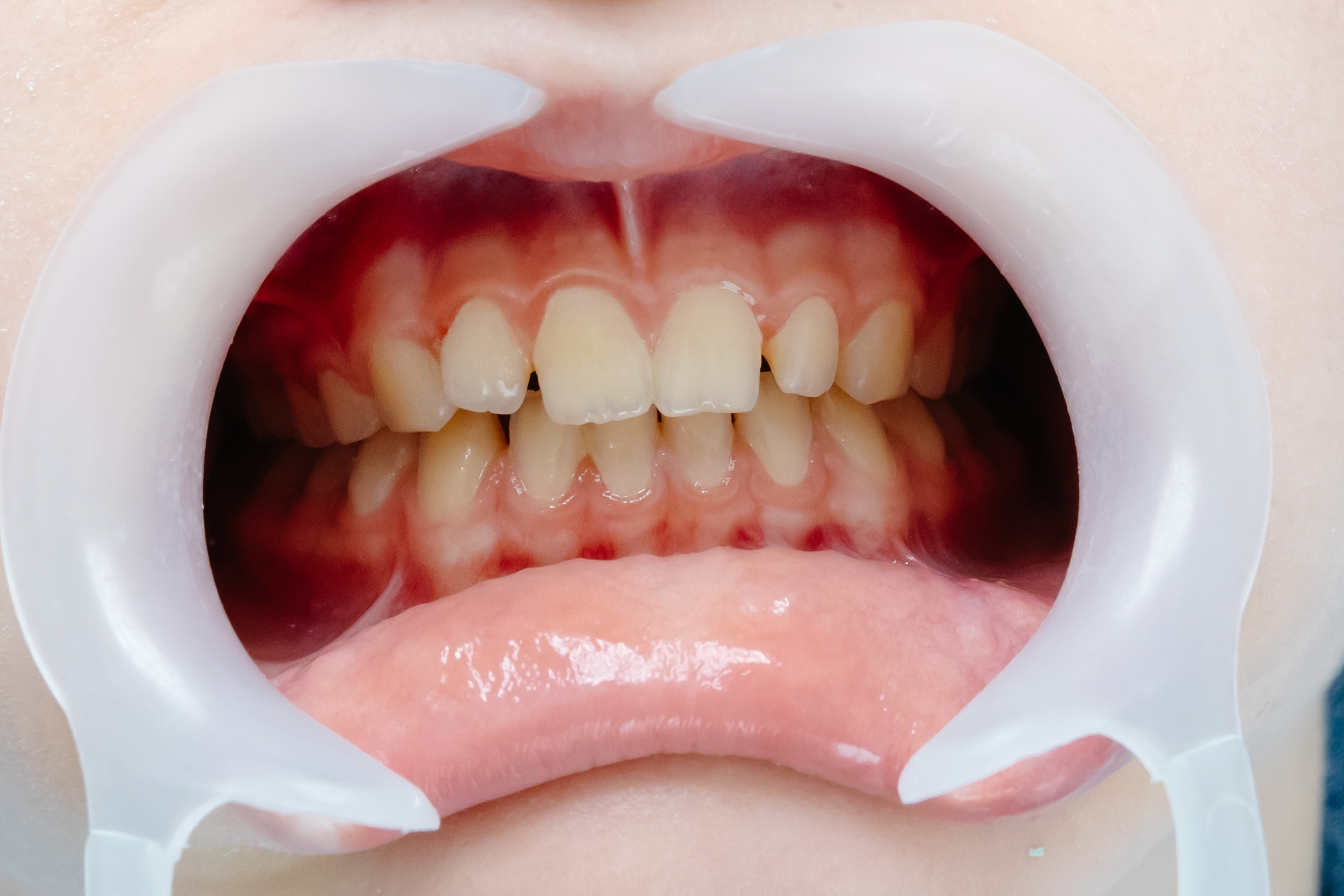 5 Hacks for Reversing Gum Disease: A Comprehensive Guide