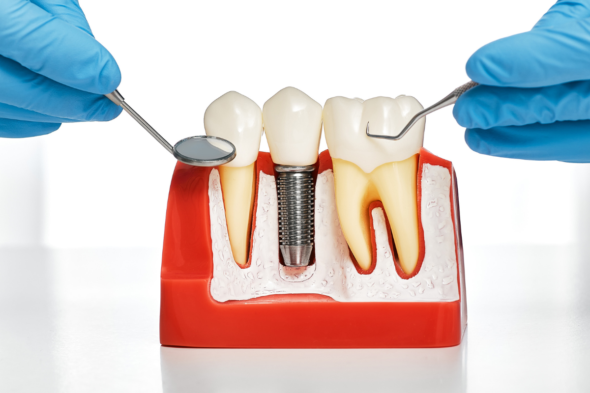 Can You Have Dental Implants with Gum Disease?