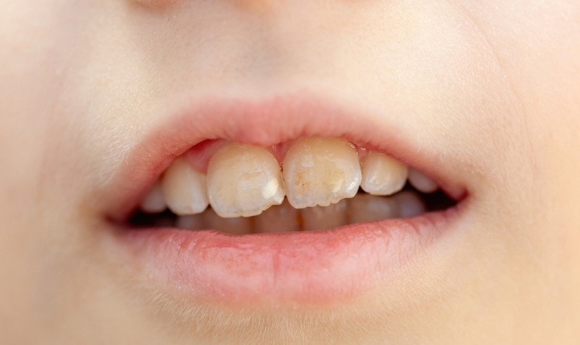 Treatments for White Spots on Teeth